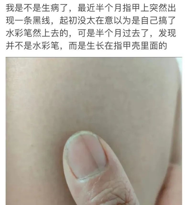 指甲出現(xiàn)一條黑線 別不當(dāng)回事！可能是癌變