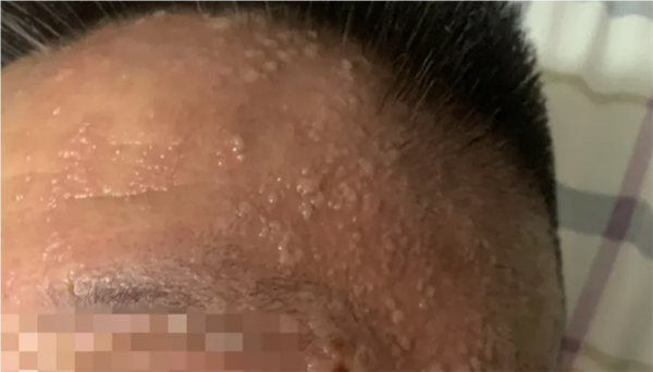 男子每天炫10斤西瓜致帶狀皰疹 醫(yī)生：糖尿病患者感染風險更高